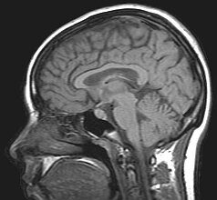 10 People Who Gained Genius from Brain Damage