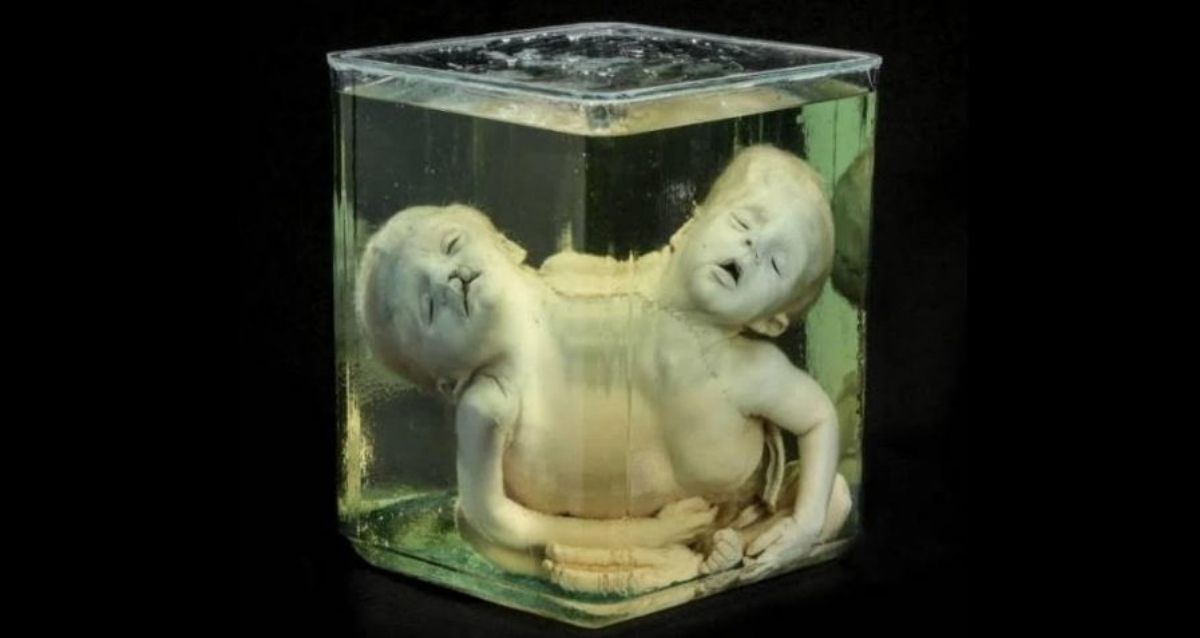 The Mütter Museum’s 44 Most Curious Medical Oddities