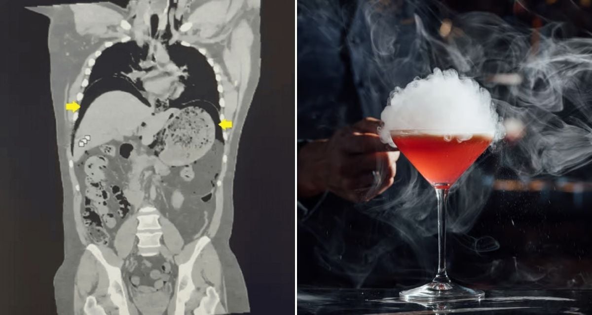 Liquid Nitrogen-Infused Cocktail Ruptures Man’s Stomach