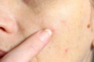 Top 10 Grossest Facts About Human Skin