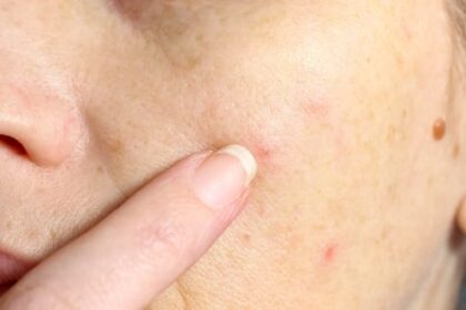 Top 10 Grossest Facts About Human Skin