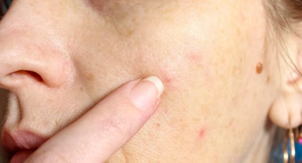 Top 10 Grossest Facts About Human Skin